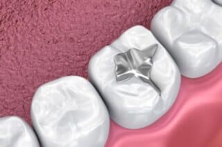 Dental Sealants El Cajon